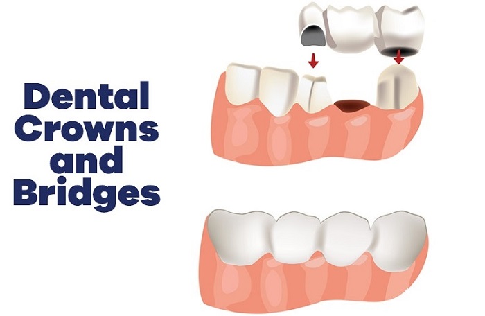 Dental Crowns & Bridge