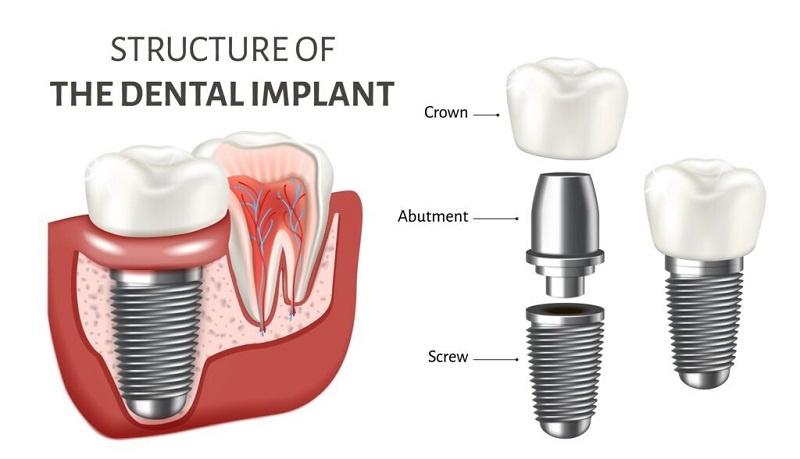 Dental Implants